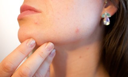Feiten en fabels over acne